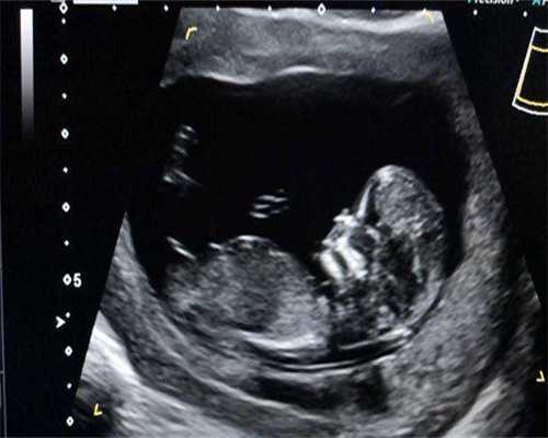 助孕选性别包成功_代生包生孩子,孕期查出封闭抗体阴性保胎需要打多久肝素？