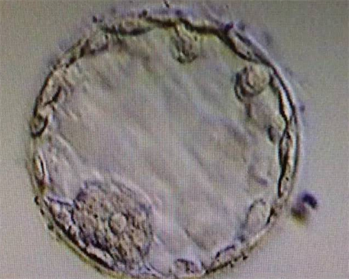 代生包生儿子吗_包性别包成功,有卵巢囊肿能怀孕吗！有卵巢囊肿的人能怀孕吗